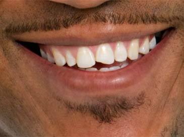 man with chipped tooth