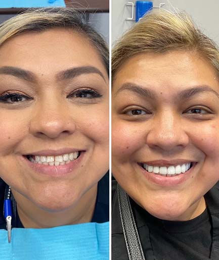 before and after smile gallery