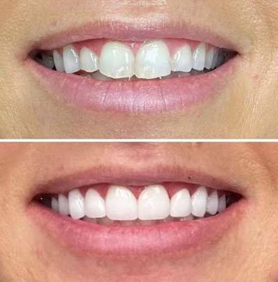 before and after smile gallery